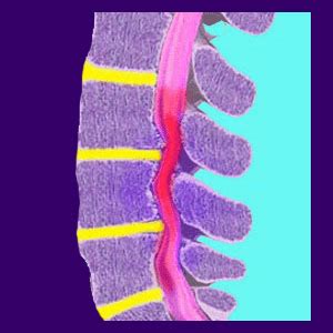 Myelomalacia - Back Pain