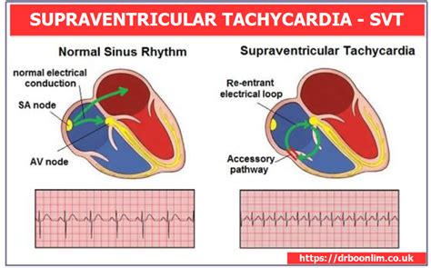 Supraventricular tachycardia symptoms and causes – Artofit