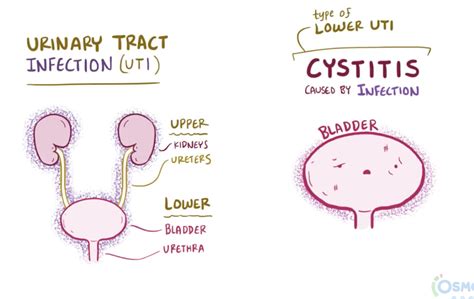 Cystitis Flashcards | Memorang