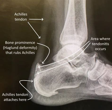 tendon achilles tendonitis : causes , symptoms ,diagnosis & treatments