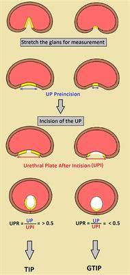 Frontiers | When to Graft the Incised Plate During TIP Repair? A Suggested Algorithm That may ...