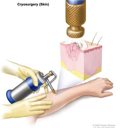 Cryotherapy or Cryosurgery - DR. NOVIKOV WELLNESS AND SKIN CARE