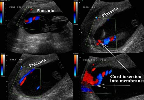 Velamentous cord | Membrane, Ultrasound, Placenta