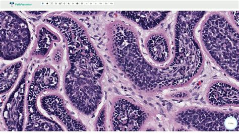 Cylindroma - Histopathology - YouTube