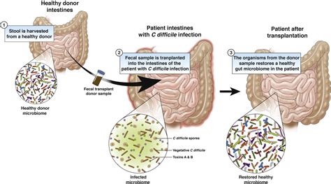 Fecal Transplant: Principle, Procedure, Uses • Microbe Online