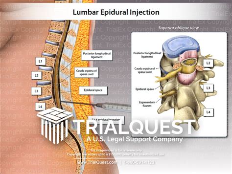 Lumbar Epidural Injection - TrialQuest Inc.