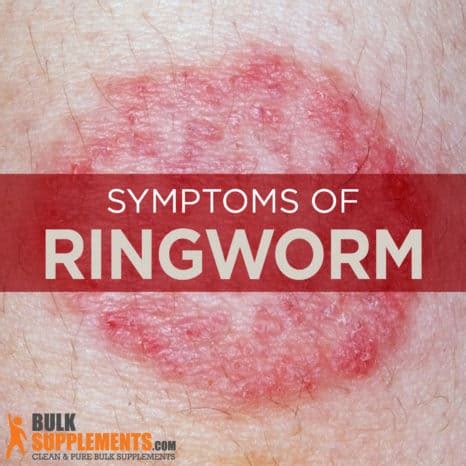 Ringworm: Symptoms, Causes & Treatment