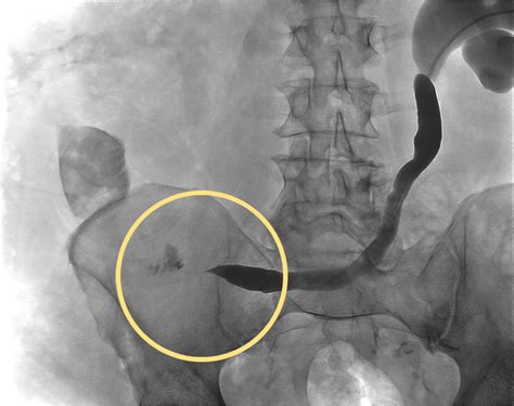 Urinary Obstruction and Ureteral Stricture: Causes and Treatment