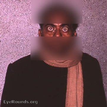 Bilateral exophthalmos. EyeRounds.org: Online Ophthalmic Atlas