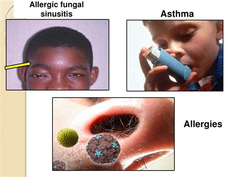 Nasal polyps (2)