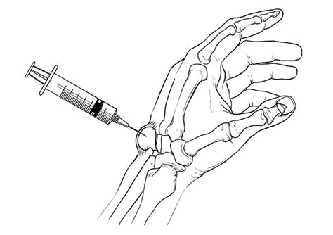 Ganglion Cyst of the Wrist and Hand - Mendelson Kornblum