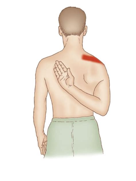 Supraspinatus Muscle - Arm Raising Pain - West Suburban Pain Relief