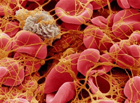 Platelet Count - High & Low Platelet Count, Causes & Treatment