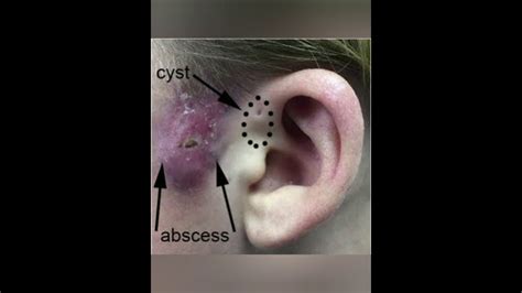 Excision of preauricular sinus (supraauricular approach)(surgical video)(26/02/2021) - YouTube