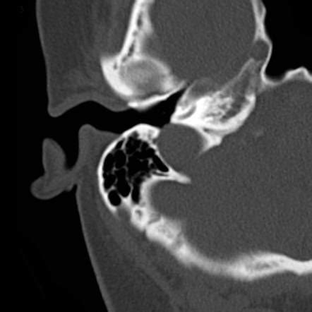 Dehiscent jugular bulb | Radiology Reference Article | Radiopaedia.org