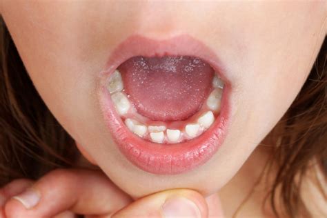 Mint Kids Dentistry - How to Deal with Over-Retained Baby Teeth? — Mint Kids Dentistry