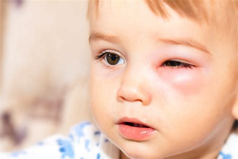 Eye Infections in Baby, Children & Adults - Causes, Diagnosis & Treatment