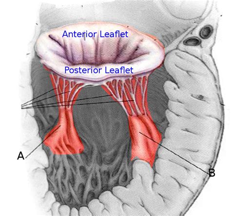 [Figure, Papillary muscles. Image courtesy S Bhimji MD] - StatPearls ...