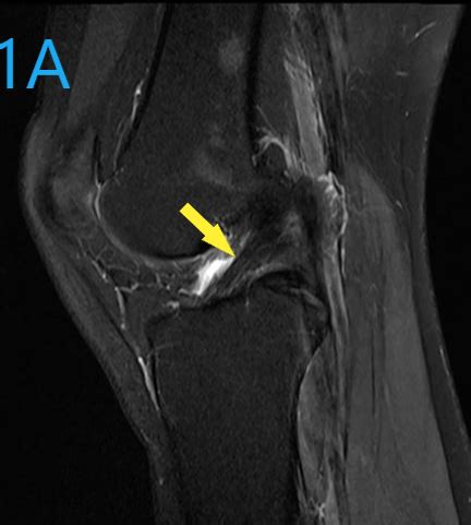 MRI- Finding the Cause of Knee Pain | Rockville MD | Radiology Center