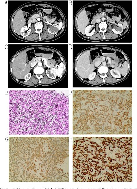 Figure 1 from Mucinous tubular and spindle cell carcinoma of the kidney: Five case reports and ...