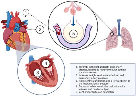 Frontiers | Hemodynamic and respiratory support in pulmonary embolism: a narrative review