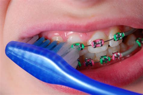 How To Brush Your Teeth With Braces : What Happens If You Have Braces ...