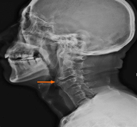 Cervical Ankylosing Spondylitis X Ray