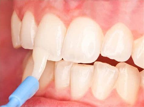 Fluoride Treatment - South Bay Dentistry & Orthodontics