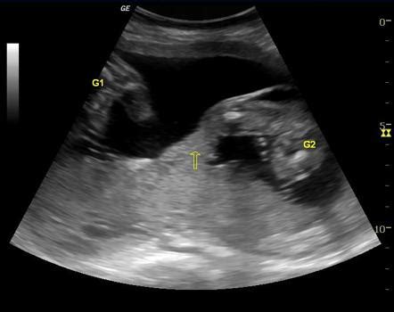 Identical Twins Ultrasound 5 Weeks