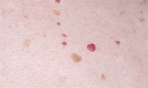 Effective Cherry Angioma Removal | Treatment at Eden Medical