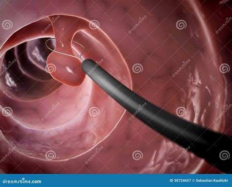 Polyp removal stock illustration. Illustration of surgery - 30724657