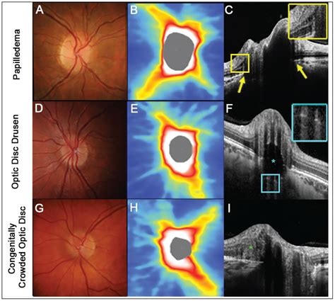 Six Questions About the Role of OCT in Neuro Evaluations