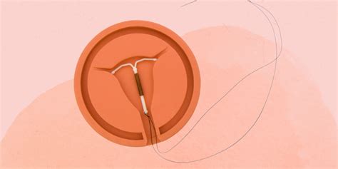 IUD Removal: How It Works and Side Effects to Expect | SELF