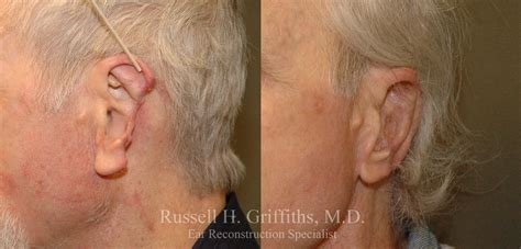 Case 1 - Ear Reconstruction from Cancer or Trauma - Before and After Gallery