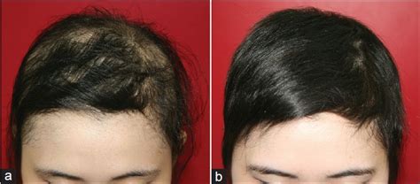 Diffuse alopecia areata is associated with intense inflammatory infiltration and CD8+ T cells in ...