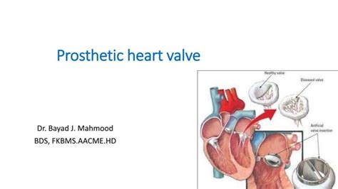 prosthetic heart valve.pptx