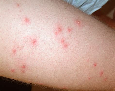 Pseudomonas Folliculitis - Symptoms, Treatment, Pictures, Causes