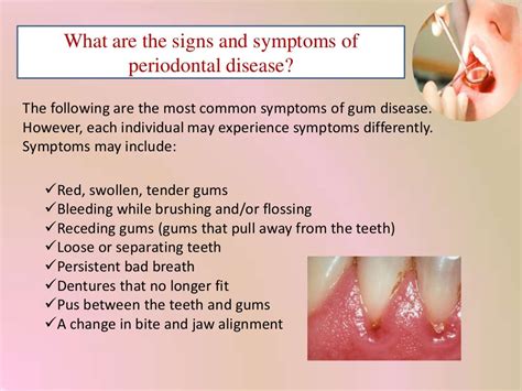 What are periodontal diseases?