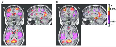 Selected images showing level of caudate activation in the recent (A)... | Download Scientific ...