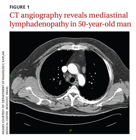 Two men with dyspnea, enlarged lymph nodes • Dx? | MDedge Family Medicine