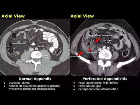 Appendix CT Scan Normal Vs Appendicitis Images | Acute, Gangrenous ...