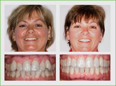 Invisalign Before and After – Orlando, FL