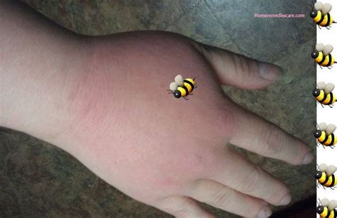 14 Home Remedies for Bee Sting That Really Work