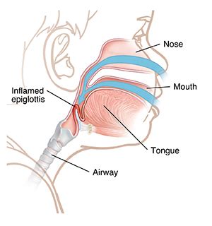 When Your Child Has Epiglottitis | Saint Luke's Health System