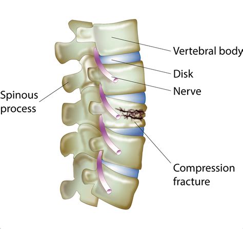 Compression Fractures of the Spine - Dr. Lani Simpson