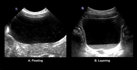 Bladder debris on renal and bladder ultrasound: A significant predictor ...