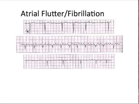 Atrial fibrillation vs flutter - Trosarab