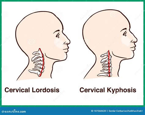 Normal Vs. Reversal of Cervical Lordosis Stock Vector - Illustration of alignment, patient ...