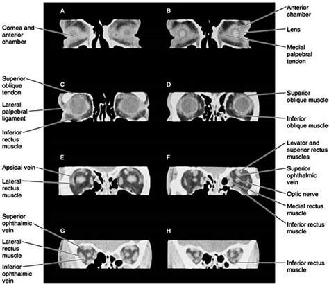 Human Anatomy: Orbit CT scan Anatomy