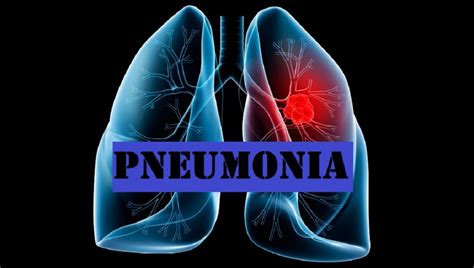 Pneumonia Prevention Tips for Senior Care Providers - SeniorNews